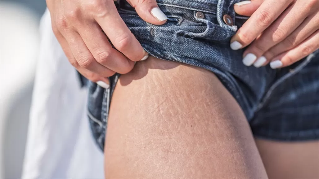 اتبع هذا النظام الغذائي للقضاء على السيلوليت