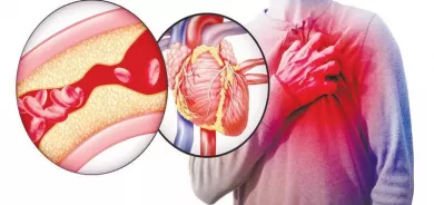 اطعمة تسبب تجلط الدم