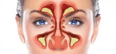 أهم العلاجات الطبيعية لالتهاب الجيوب الأنفية