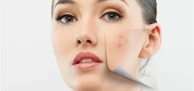 للتخلص من البثور بسرعة... اتبعي هذه النصائح!