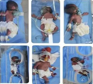 أربيل.. امرأة تضع 6 توائم في أحد مستشفيات المدينة