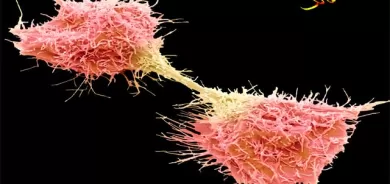 شێرپەنجە - Cancer