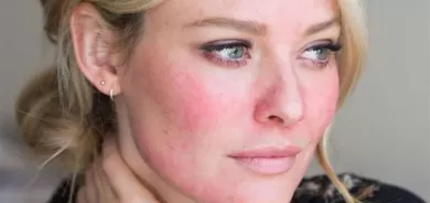 البشرة الحساسة.. علاماتها ونصائح العناية بها