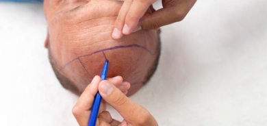 تەمەنی گونجاو بۆ چاندنی قژ