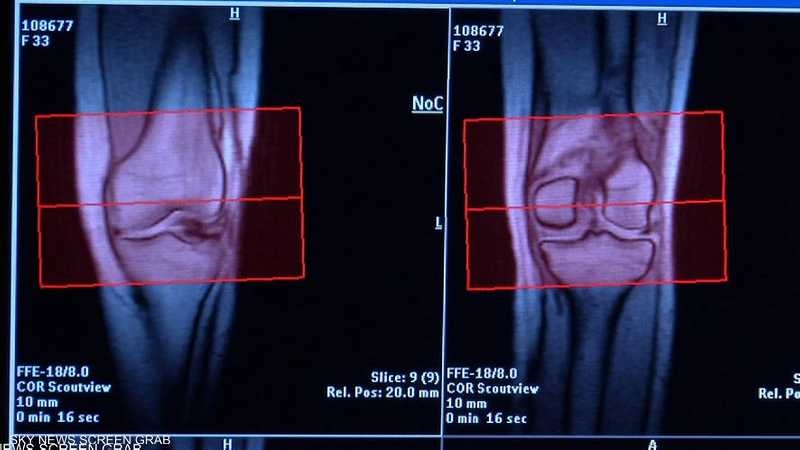 آلام المفاصل والشتاء و