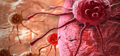 لا تتجاهلهم.. 5 إشارات تنذر بإصابتك بالسرطان