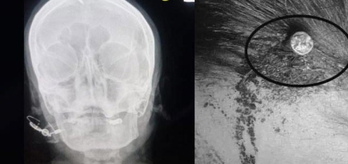 داكوتینی بزمار بە سەری  ئافرەتانی  دووگیاندا