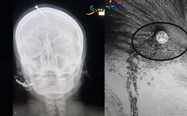 داكوتینی بزمار بە سەری  ئافرەتانی  دووگیاندا