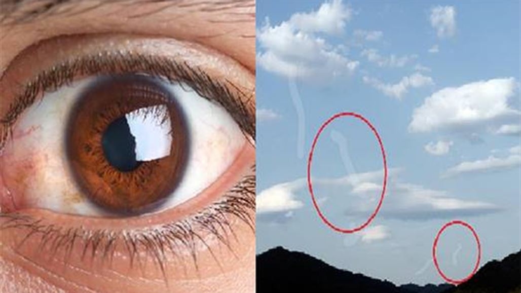 أترى بقعاً صغيرة تتحرك أمام عينيك؟ إكتشف السّبب