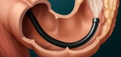 تنظير القولون .. هل يحميك من السرطان؟