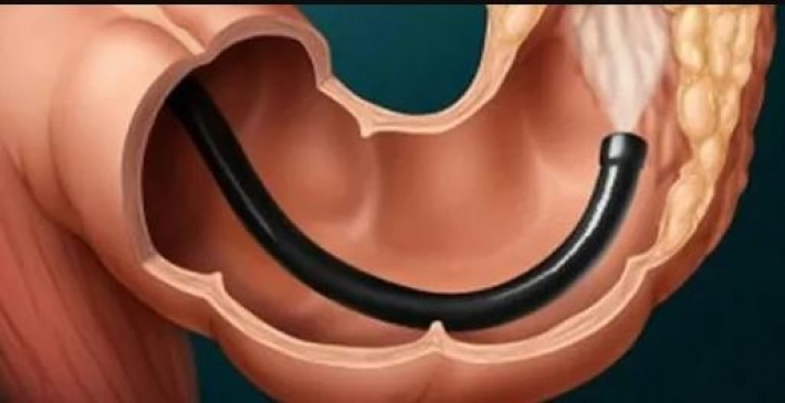 تنظير القولون .. هل يحميك من السرطان؟