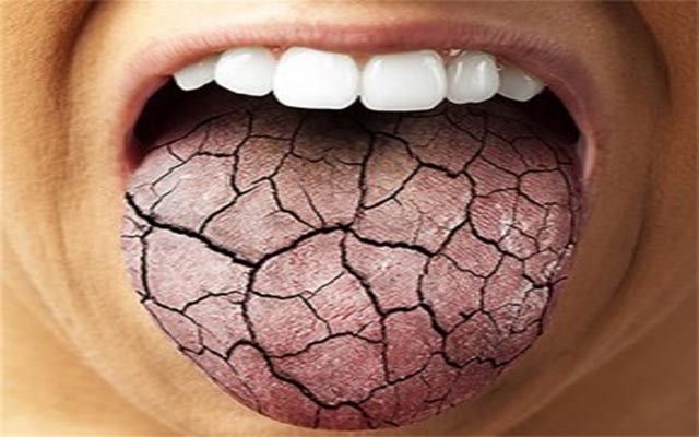 وشكبوونی دەم لە ڕەمەزاندا