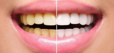 مخاطر لجلسات تبييض الأسنان.. تعرف على الاضرار