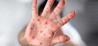 فيروس جدري القرود .. هل تم رصد أول حالة في العراق؟