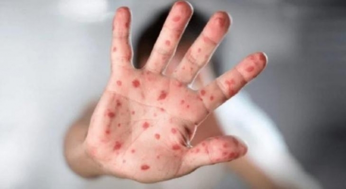 فيروس جدري القرود .. هل تم رصد أول حالة في العراق؟