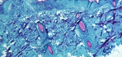 اليونان ترصد أول إصابة محتملة بـ«جدري القردة»