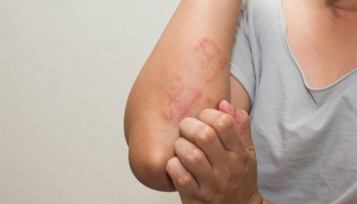 الإكزيما تتضاعف في الصيف .. 7 نصائح للوقاية