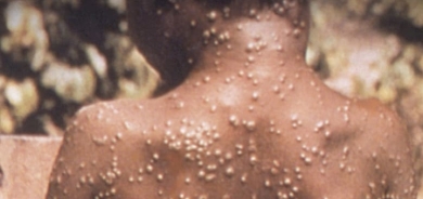 WHO li ser zêdebûna haletên Xuriya Meymûn hişyariyê dide