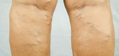 طبيبة روسية توضح كيفية منع ظهور الدوالي