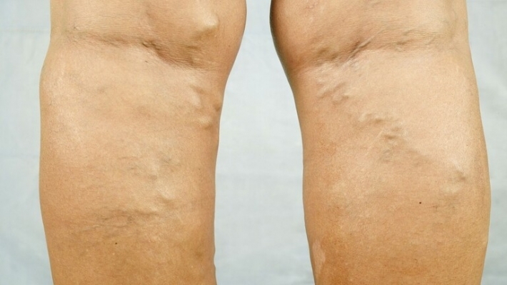 طبيبة روسية توضح كيفية منع ظهور الدوالي