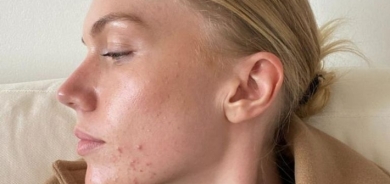 أعراض تحذرك من خطورة الجلوس طويلا.. حب الشباب أحدها