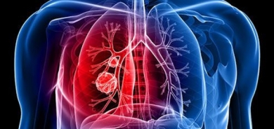 طبيب يحذر: سرطان الرئة لا ينجم عن التدخين فقط