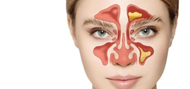 التهاب مزمن في الجيوب الأنفية