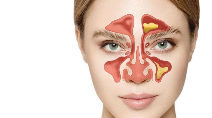 التهاب مزمن في الجيوب الأنفية