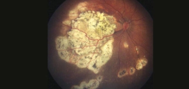 علاج محتمل لسرطان العين عند الأطفال