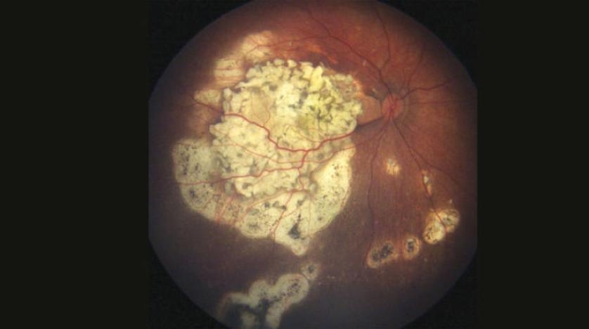 علاج محتمل لسرطان العين عند الأطفال