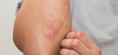 هذه المواد الأكثر تسبّباً لنوبات الحساسيّة