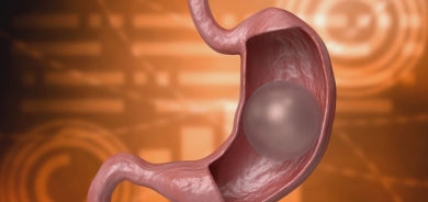 لا تحتاج إلى جراحة .. ما هي عملية “بالون المعدة”؟