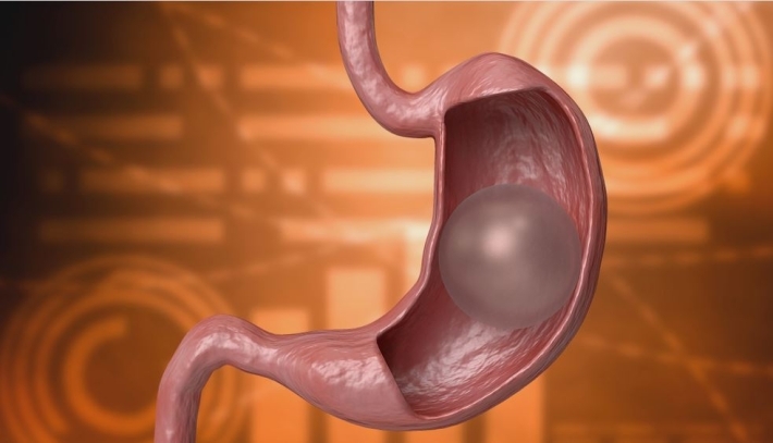 لا تحتاج إلى جراحة .. ما هي عملية “بالون المعدة”؟