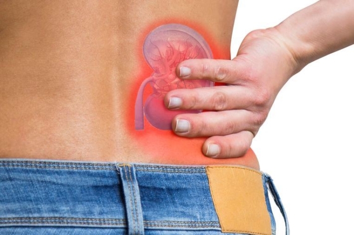 حصوات الكلى.. 7 أعراض تحذيرية لا تتجاهلها