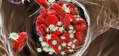 هذه الأطعمة قد تزيد خطر الإصابة بجلطات دمويّة