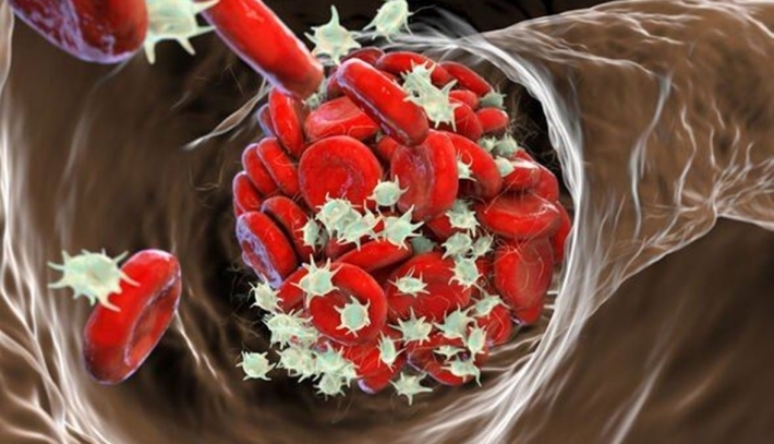 هذه الأطعمة قد تزيد خطر الإصابة بجلطات دمويّة