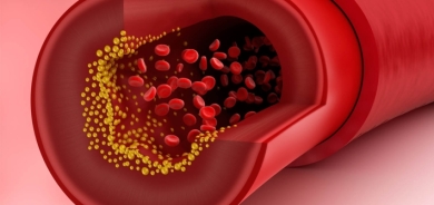 أول علامة على انسداد الشرايين بسبب الكوليسترول
