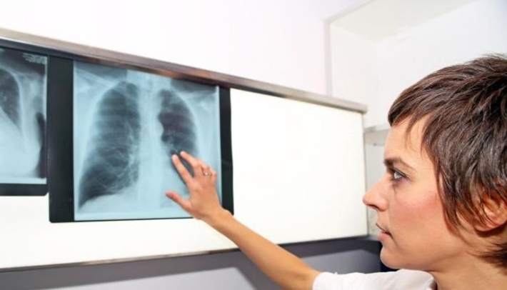 أسباب وأعراض الانسداد الرئوي.. احذر زيادة الوزن