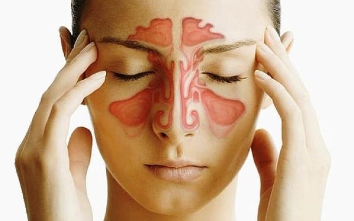 طبيب روسي يكشف طرق علاج التهاب الجيوب الأنفية