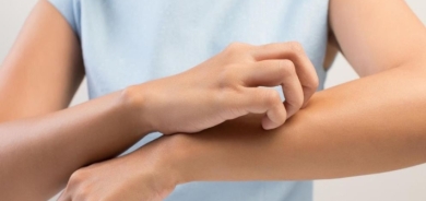 كمادات الشاي.. علاج طبيعي لحكة التهاب الجلد