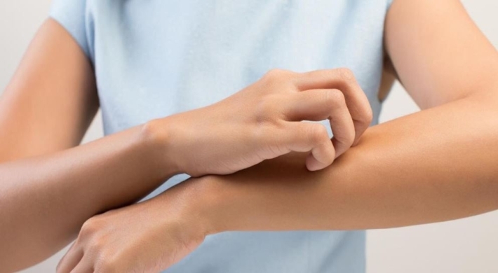 كمادات الشاي.. علاج طبيعي لحكة التهاب الجلد