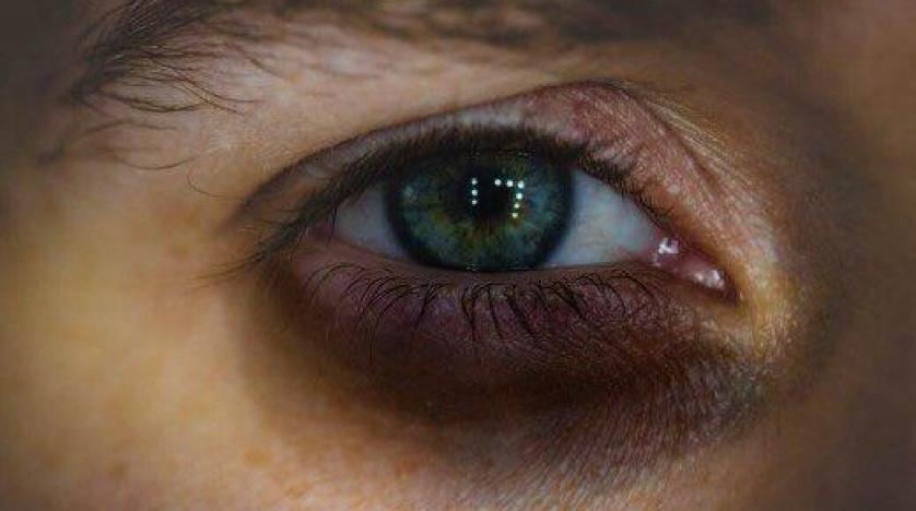 8 علاجات طبيعية للهالات السوداء حول العين