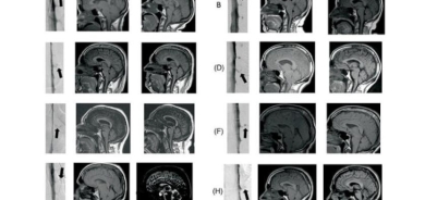 اكتشاف سبب مجهول للخرف