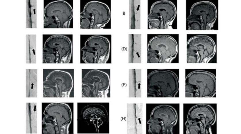اكتشاف سبب مجهول للخرف
