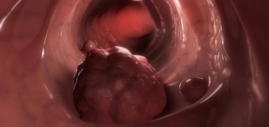 سرطان القولون.. علامات تحذيرية وأعراض مبكرة!