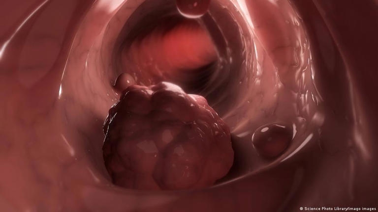 سرطان القولون.. علامات تحذيرية وأعراض مبكرة!