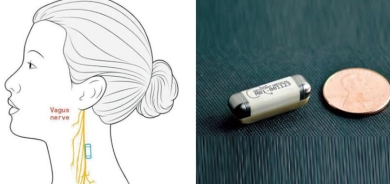 علاجات إلكترونية لالتهاب المفاصل