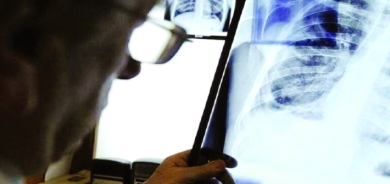 علماء يكتشفون بروتيناً في الرئتين يمنع انتشار «كورونا»