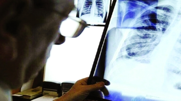 علماء يكتشفون بروتيناً في الرئتين يمنع انتشار «كورونا»