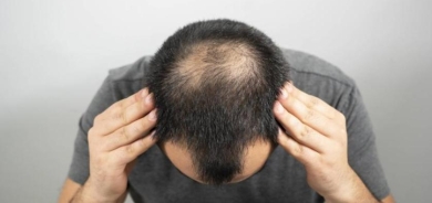 انحسار شعر الرأس... المراحل والتشخيص وخيارات العلاج